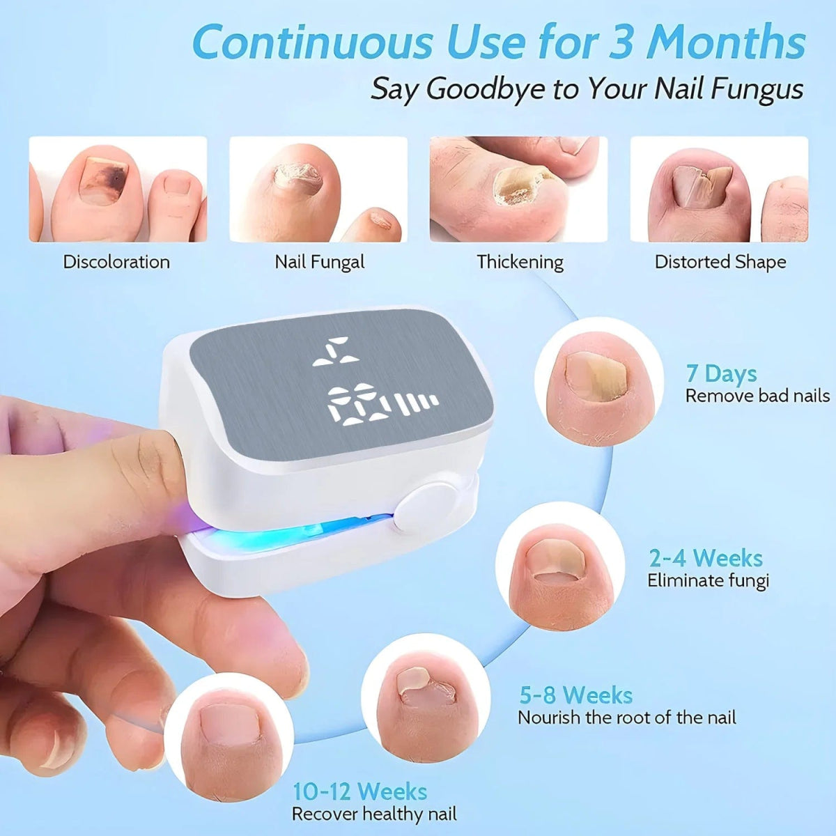 Nail Fungus Treatment Tools Fungal Nail Treatment Anti - Equipment Effectively Remove Fungal Toenail Nail Fungal Infection - SHOWLU FASHION STORE